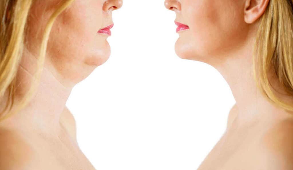 Double Chin treatment Bury before and after results