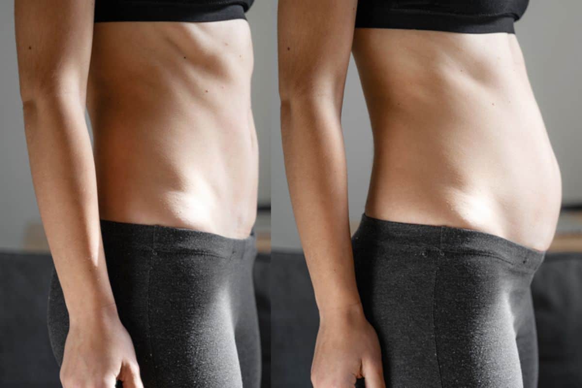 How long does diastasis recti take to improve Bury?