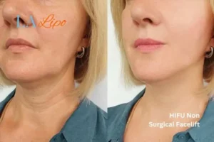 hi-fu for wrinkles Bury before and after results