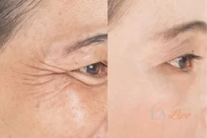 Before and after results of woman - HI-fu wrinkles reduction treatment Bury