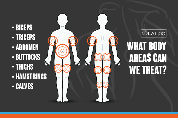 Graphic to show areas you can have LA-EMS Body Sculpting Bury treatment.
