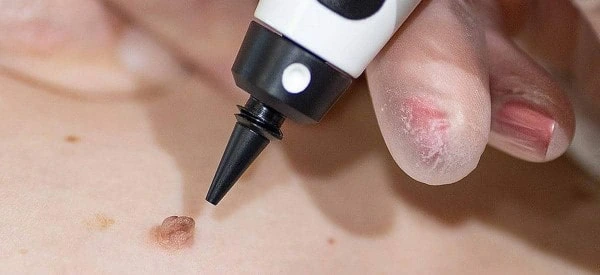 skin tag removal using cryopen Bury