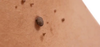 image of a skin tag Bury