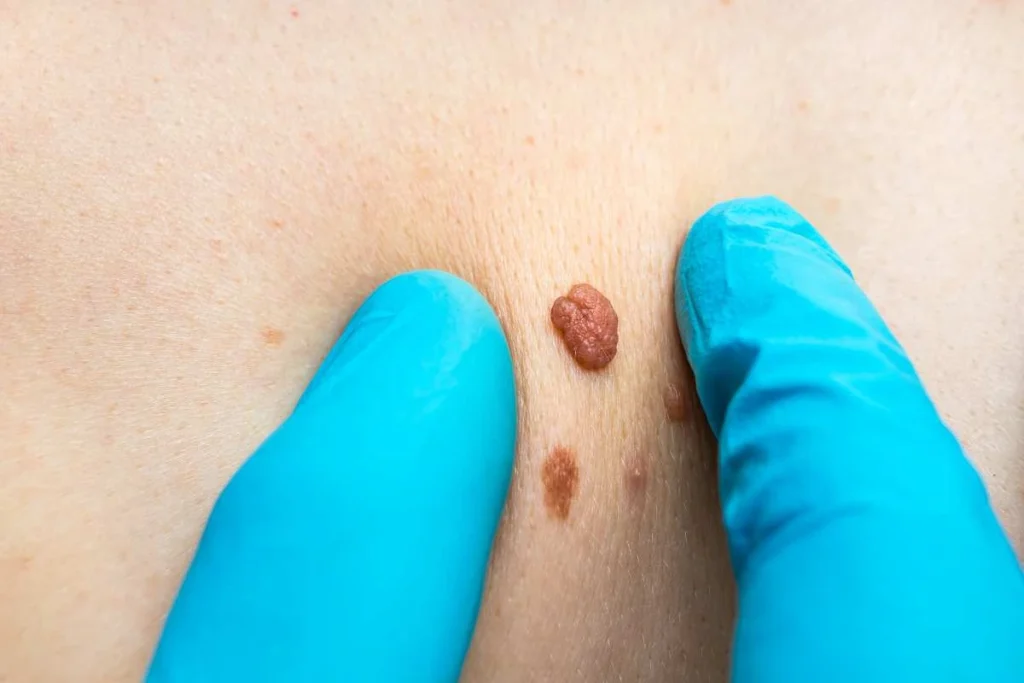 Consultant examining a skin tag Bury