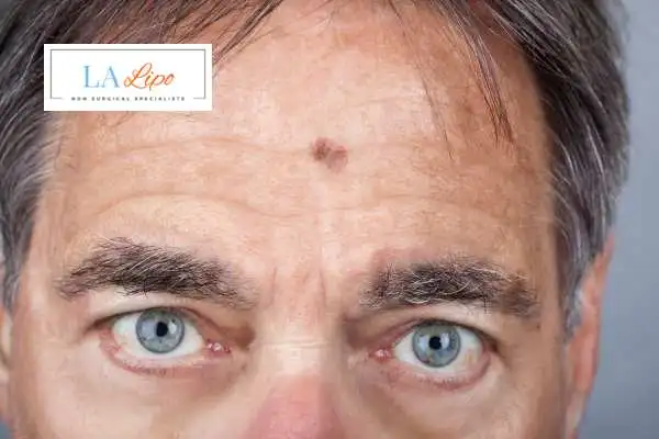 Solar Lentigo Removal Bury image of man with mark on his forehead
