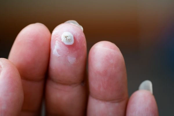 wart on person finger - cryotherapy to treat from LA LIPO Bury