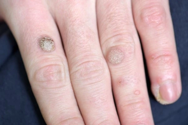 photo of warts on person hand - see wart removal Bury from LA LIPO