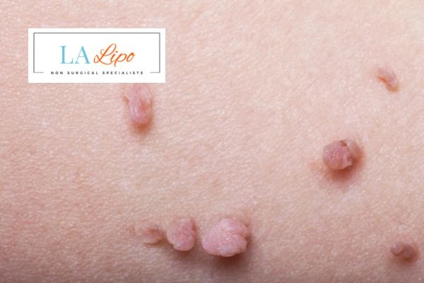 Does cryopen skin tag removal Bury hurt? Find out now call our team today!