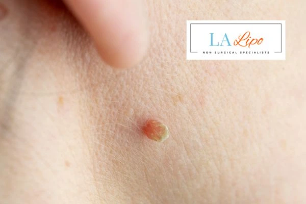 Book skin tag removal Bury today speak to our team now!