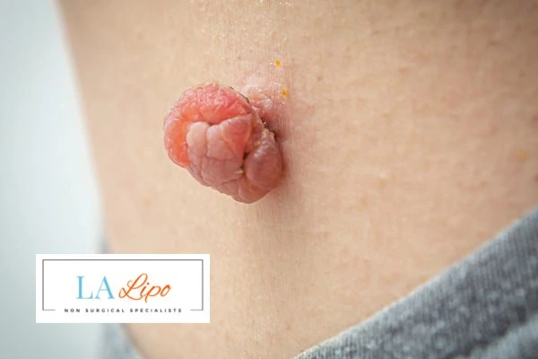 Interested in skin tag removal Bury? Concerned about the pain? Find out more today!
