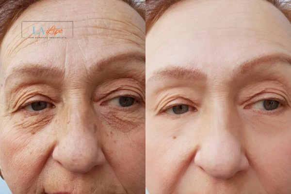 The powerful benefits of Morpheus8 Treatment Bury - Call Our team today!