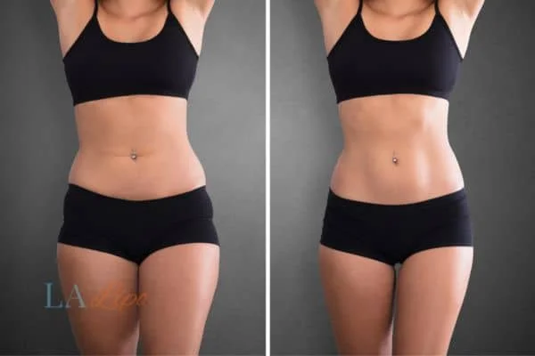 before and after results of non-surgical treatment to help a woman's body image and mental health Bury