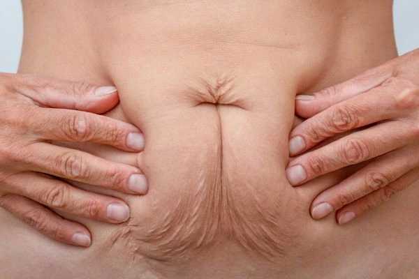 Should I Combine Diastasis Recti Treatment with Body Contouring for Better Results Bury?