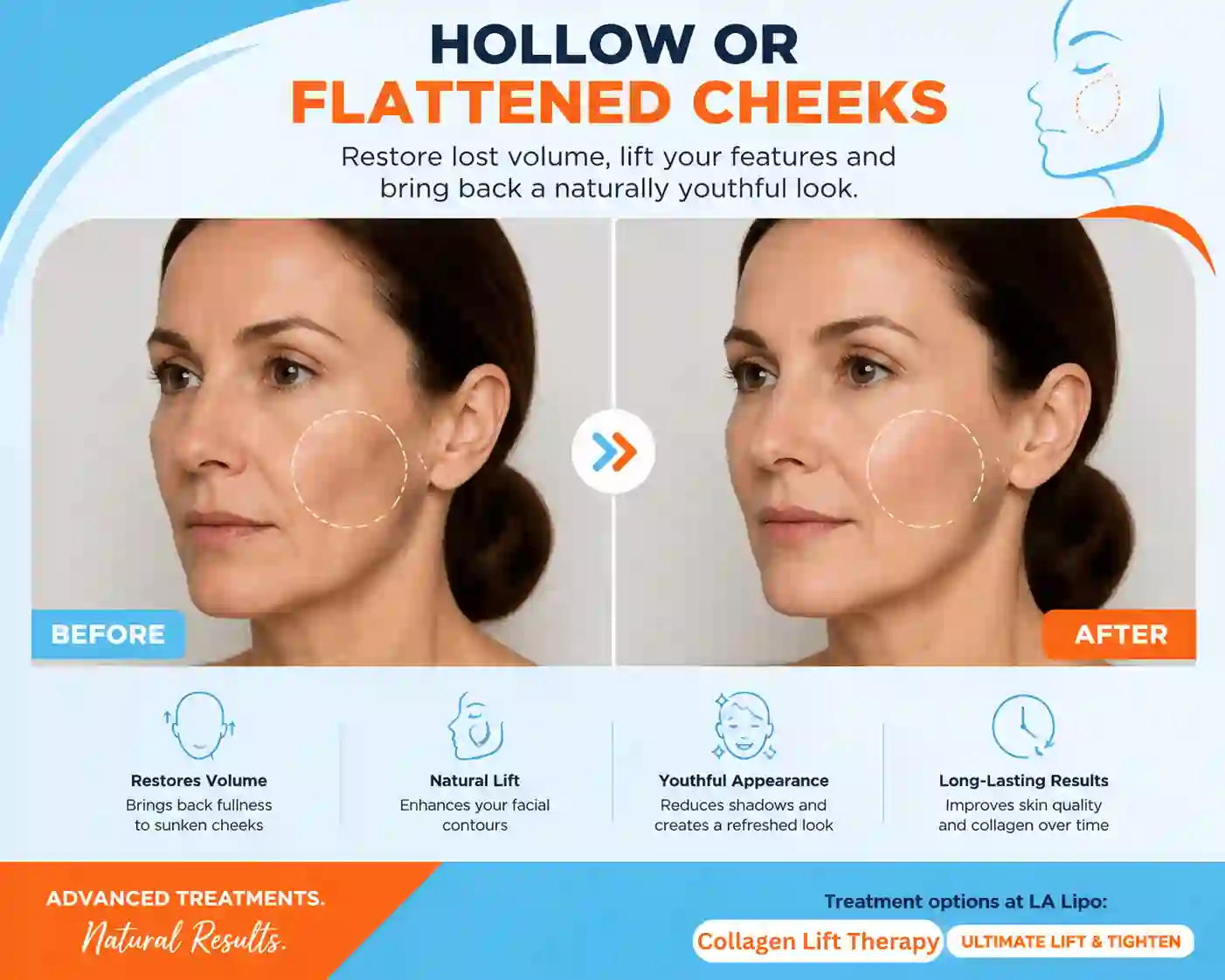 Sign #4: Hollow or Flattened Cheeks Bury