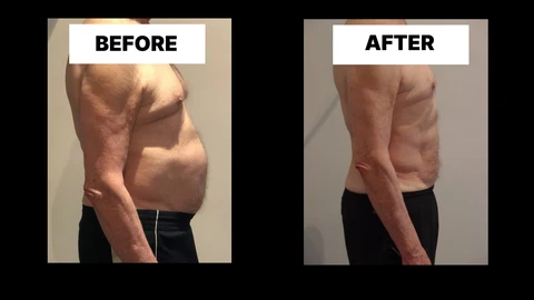 What Symptoms Can Diastasis Recti Cause in Men? Weak Core, Back Pain and Poor Posture Bury